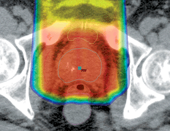 Image: An example of the Smart Segmentation Knowledge-based Contouring technique (Photo courtesy of Varian Medical Systems).